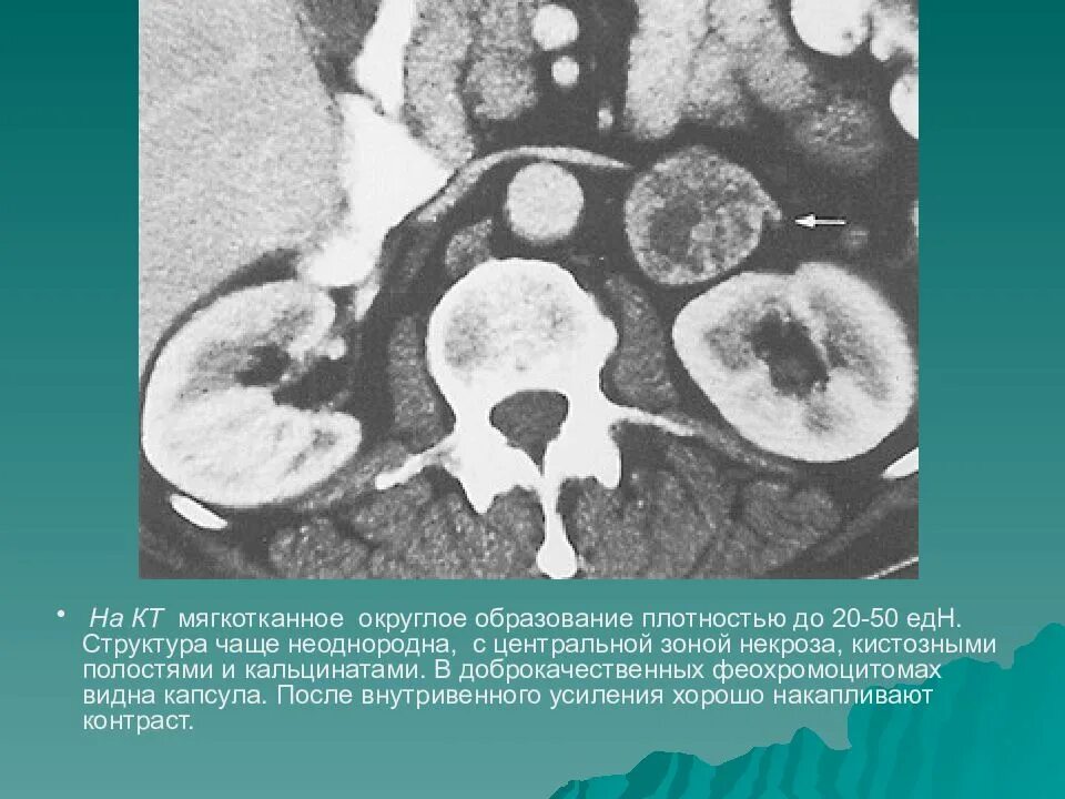 Образование кт. Феохромоцитома надпочечника кт контраст. жировое образование надпочечника кт. образования надпочечников на кт. доброкачественные опухоли надпочечников на кт.