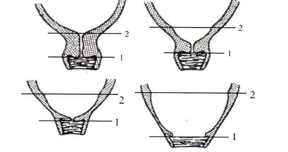 Зев т образный. Наружный зев шейки матки щелевидный. шейка матки наружный зев сомкнут. раскрытие зева шейки матки. открытый наружный зев шейки матки.