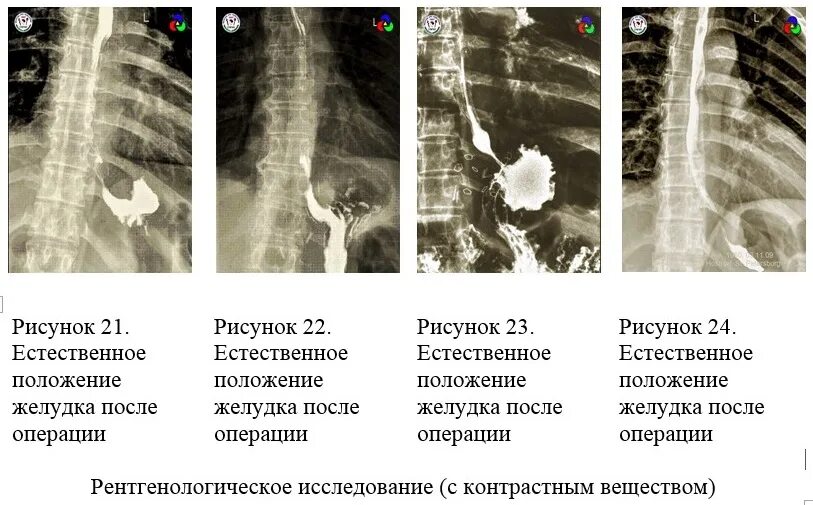Ущемление грыжи диафрагмы. Грыжа пищеводного отверстия диафрагмы клинические рекомендации. рентгенологическое исследование грыжи. рентгенологическое исследование гэрб. грыжа пищеводного отдела диафрагмы на узи.