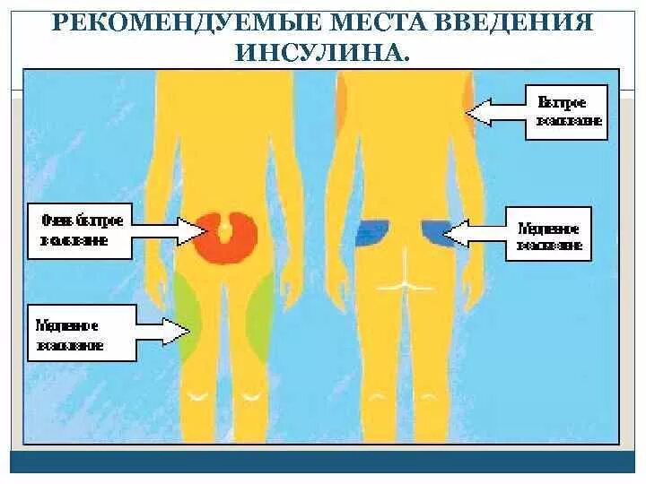 После инъекции инсулина пациент. Место для инъекции инсулина в бедро. Места введения инсулина схема. Места введения инсулина в живот. Зоны инъекций инсулина в живот.