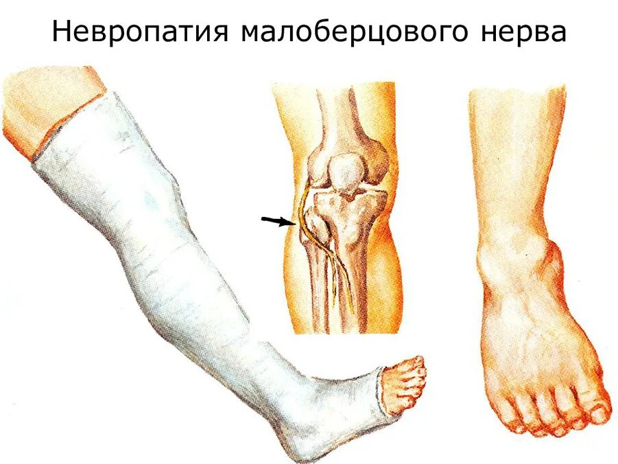 Невропатия стопы. Дистальная нейропатия малоберцового нерва. Неврит малоберцового нерва анатомия. Туннельный синдром малоберцового нерва. Туннельный синдром малоберцового нерва симптомы.