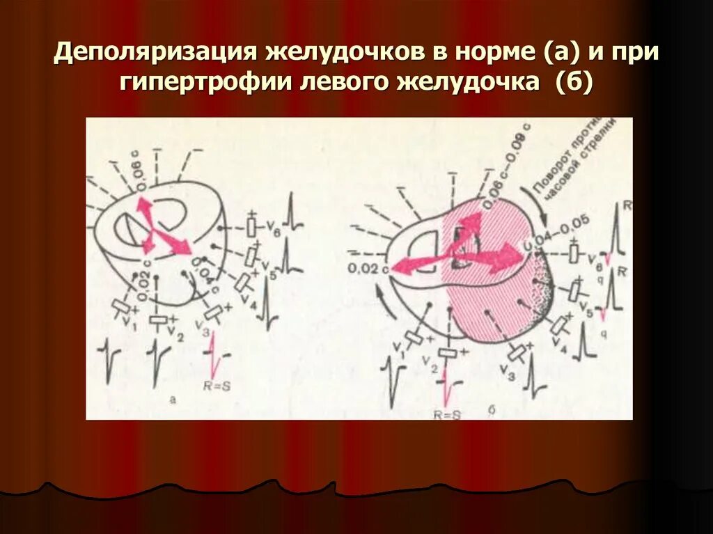 Деполяризация желудочков. Деполяризация левого желудочка. направление деполяризации в желудочках в норме. деполяризация миокарда желудочков.
