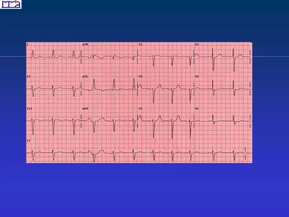 Отклонение ЭОС влево на ЭКГ. ЭКГ ритм синусовый отклонение ЭОС. Отклонение оси влево на ЭКГ. Отклонение электрической оси сердца влево на ЭКГ. Сердце отклонено вправо