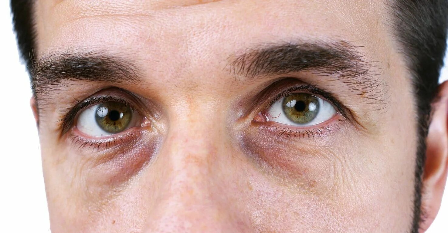Желтые круги под глазами у мужчин причина. Мешки под глазами. Круги под глазами.