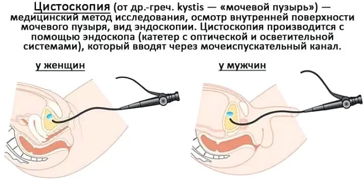 Цистоскопия мочевого пузыря у женщин как делают. Подготовка к цистоскопии мочевого пузыря. эндоскопическое исследование мочевого пузыря. диагностическая цистоскопия. подготовка к проведению цистоскопии мочевого пузыря у женщин.