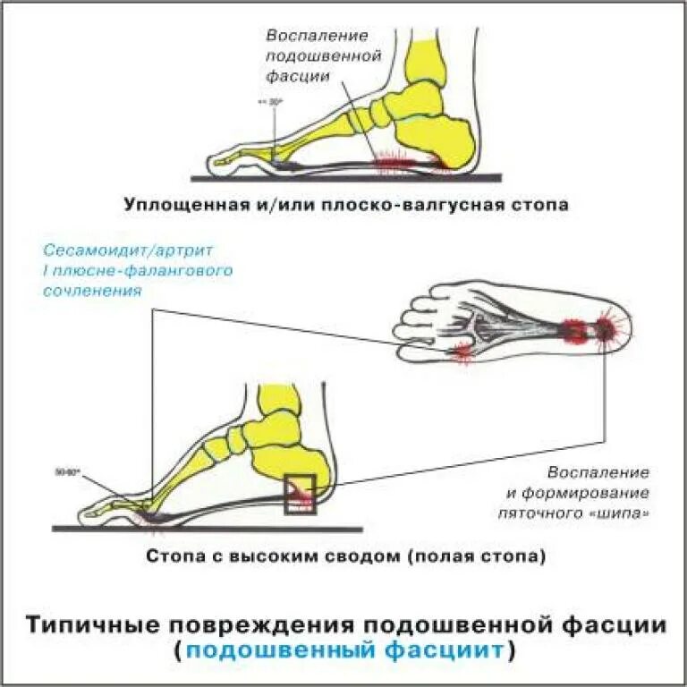 Фасциит стопы. Воспаление подошвенной фасции. Подошвенный фасциит стопы. Воспаление фасции стопы. Разрыв подошвенной фасции.