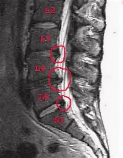 Остеохондроз поясничного отдела l5 s1. Мрт грыжа l1-l2. Межпозвонковые диски l1-l2. Протрузия диска l1 l2, l2-l3. Диск l1-l2 позвоночника.