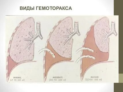 Гемоторакс
