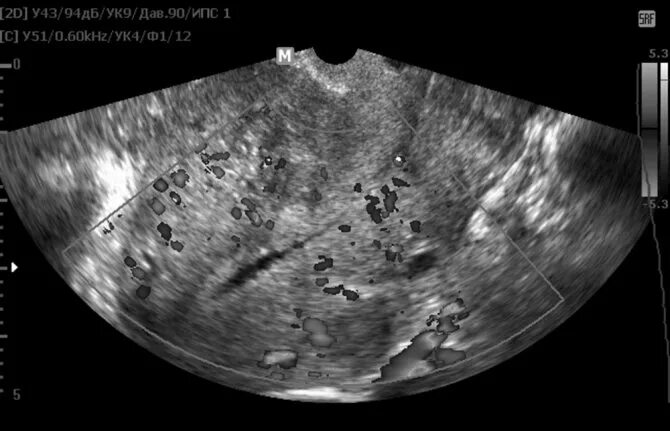 УЗИ послеоперационного рубца на матке. Рубец на матке после КС на УЗИ. Несостоятельность послеоперационного рубца на матке по УЗИ. Несостоятельный рубец на матке УЗИ.