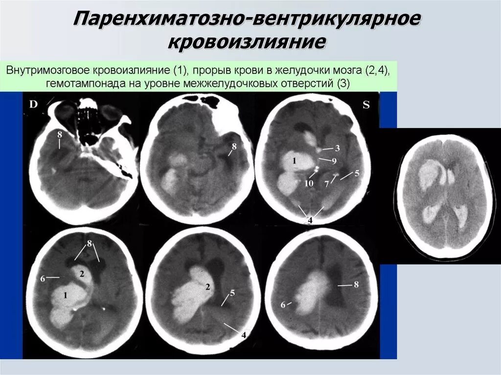 Кровоизлияние в желудочки. Интравентрикулярное кровоизлияние. Геморрагический инсульт паренхиматозное кровоизлияние клиника. Геморрагический инсульт паренхиматозно-вентрикулярное. Тампонада желудочков мозга кт.