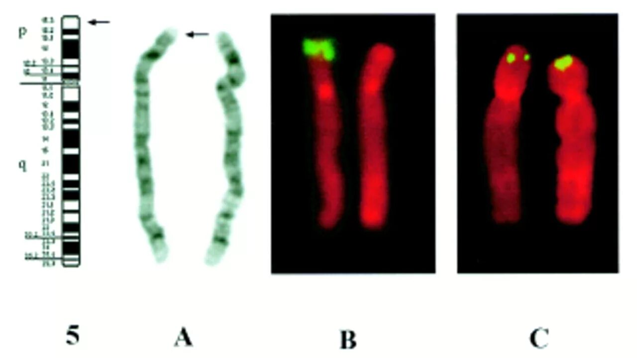 Хромосомы краба. Алкаптонурия кариотип. Алкаптонурия мутация Гена. 5 Хромосома. Пятая хромосома.