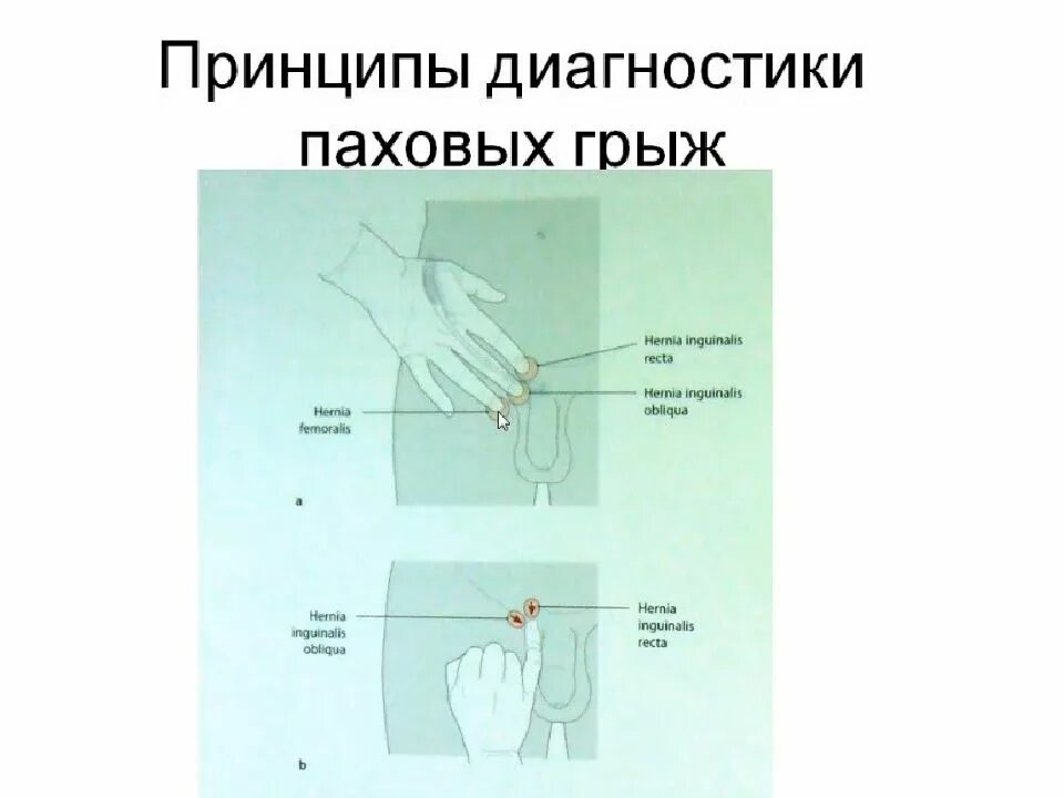 Как отличить паховую