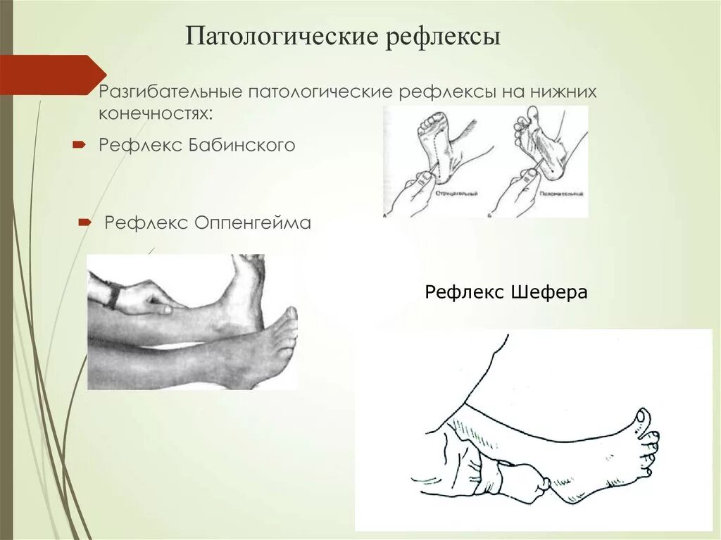 Рефлексы Бабинского Оппенгейма Гордона Шеффера Россолимо Жуковского. Рефлекс Бабинского Оппенгейма Гордона. Рефлексы Россолимо Бабинского Гордона. Рефлекс Бабинского Россолимо Жуковского.