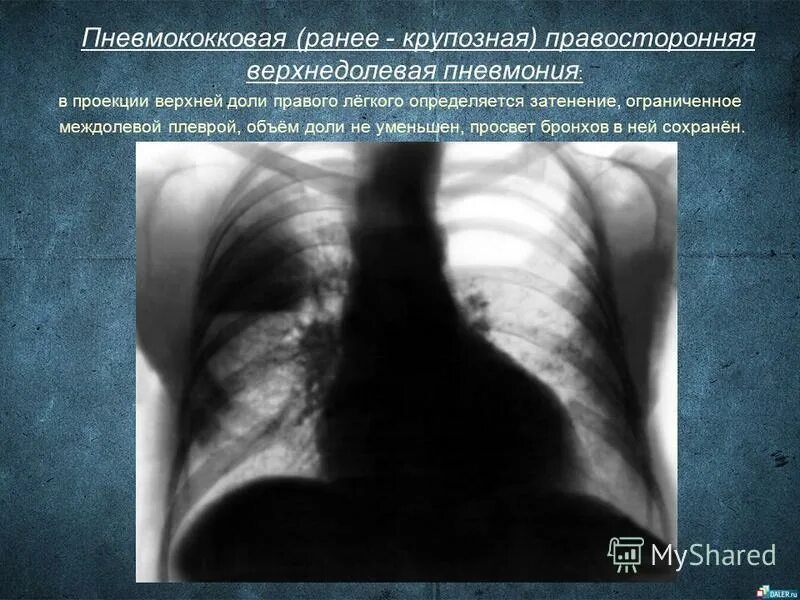 Очаговая верхнедолевая пневмония рентген. Крупозная пневмония рентген описание. Рентген легких при крупозной пневмонии. Инфильтрация легочной ткани. Изменения в верхней доле легкого