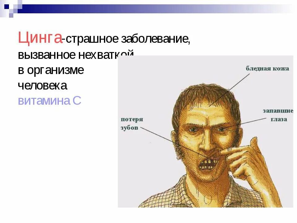 Недостаток какого витамина вызывает цингу. Цынг. Почему люди болеют цингой. Болезнь цинга презентация. Цинга (дефицит витамина с).