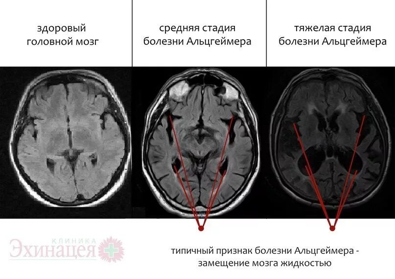 Атрофия вещества головного мозга. Кт и мрт при болезни Альцгеймера. Болезнь Альцгеймера снимки мрт. Мрт головного мозга болезнь Альцгеймера. Кт признаки болезни Альцгеймера.