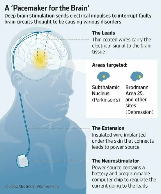 Deep signals. Deep brain. brain stimulation. electrical brain stimulation. мозг сон память.