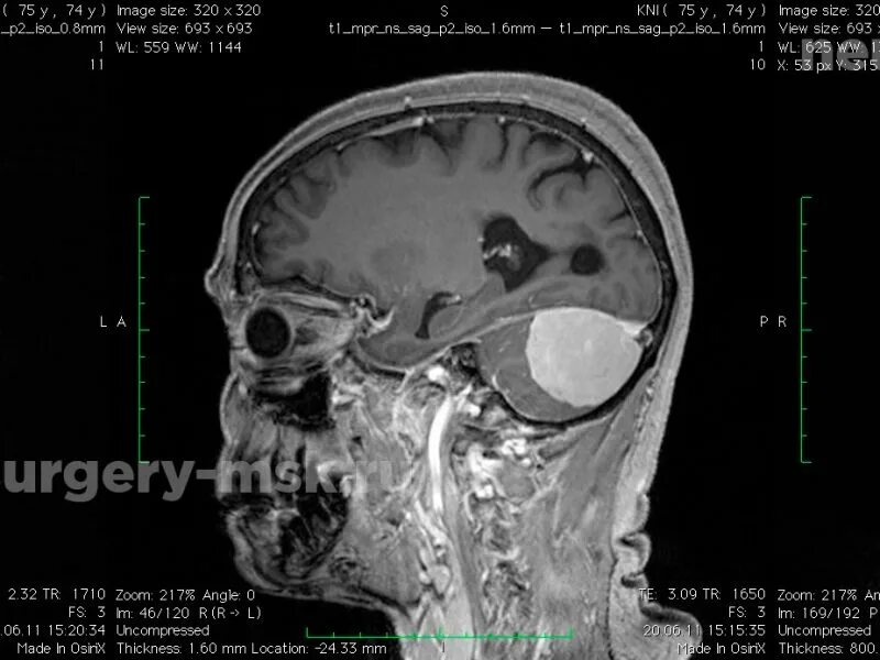 После операции менингиомы головного мозга. Менингиома мозжечка мрт. Менингиома намета мозжечка кт. Менингиомы задней черепной ямки.