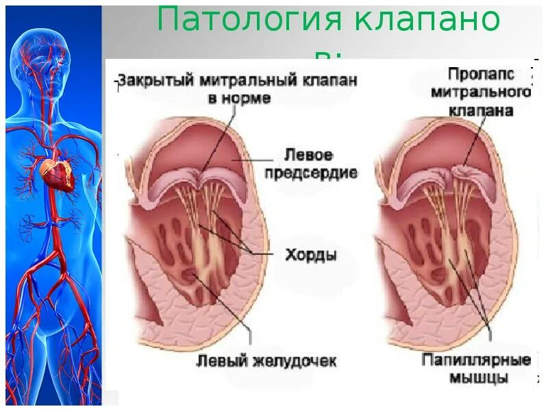 Пролабирование митрального. Пролапс митрального клапана. пролапс митрального клапана сердца. пмк пролапс митрального клапана. пролапс митрального клапана 4,5.