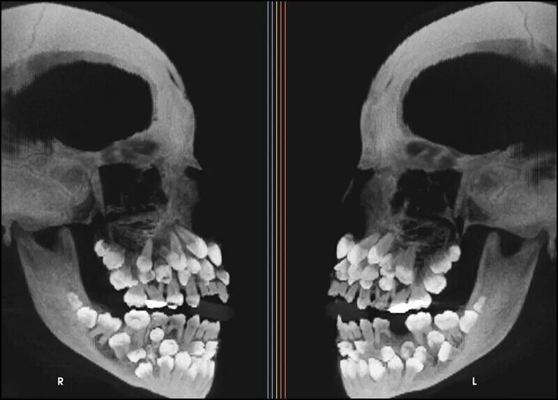 Аномалии удаления. Гипердонтией аномалия числа зубов. Полиодонтия - аномалия числа зубов,. Гипердонтия зубов рентген. Полиодонтия (сверхкомплектные зубы).