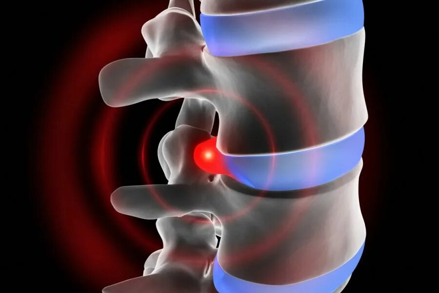 Болит ли протрузия. Протрузии межпозвоночного диска. Протрузия межпозвонкового диска. Межпозвоночная грыжа и протрузия. Грыжи и протрузии позвоночника.