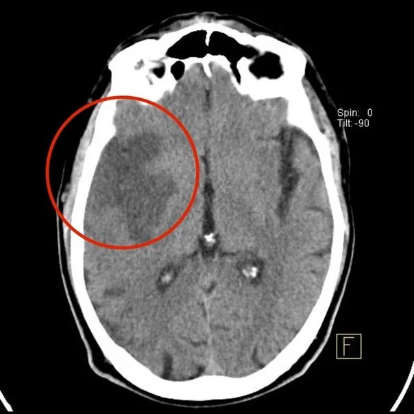 Очаг ишемии мозга. Ишемический инсульт мрт. Ишемический инсульт кт. Ишемия мозга на кт. Кт головного мозга ОНМК.