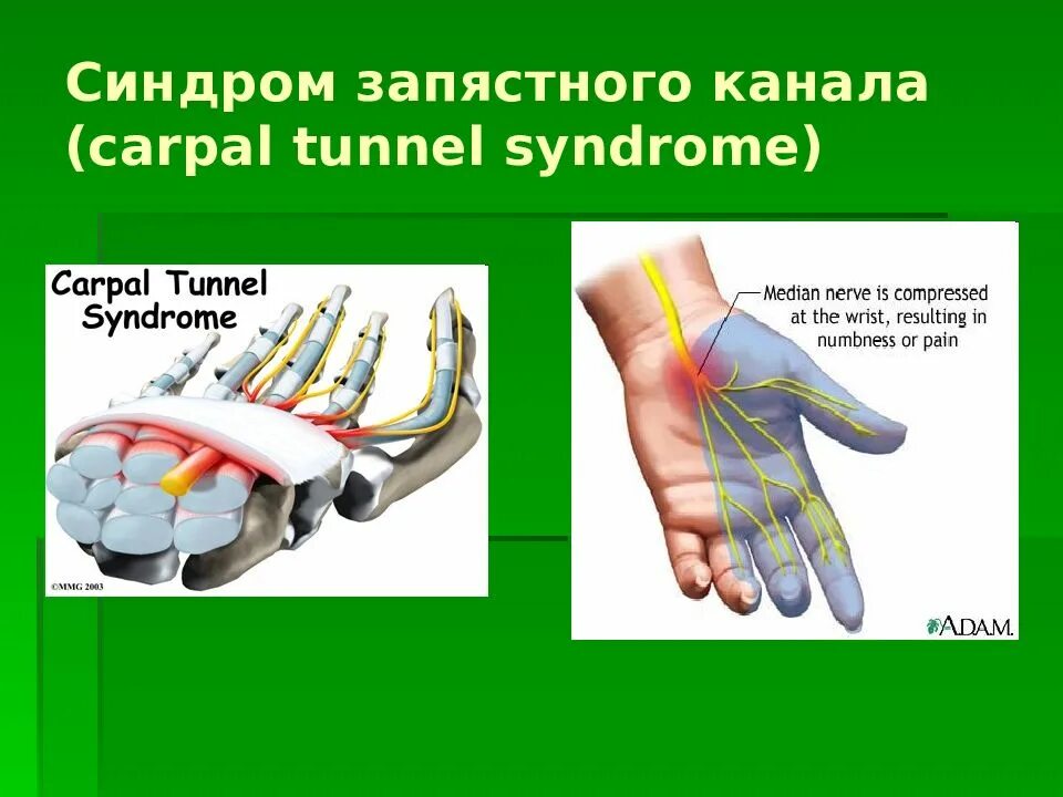 Карпальный туннельный синдром. Туннельный синдром запястья кисти. Туннельный синдром запястного сустава. Карпальный синдром запястья. Синдром карпального канала мкб 10
