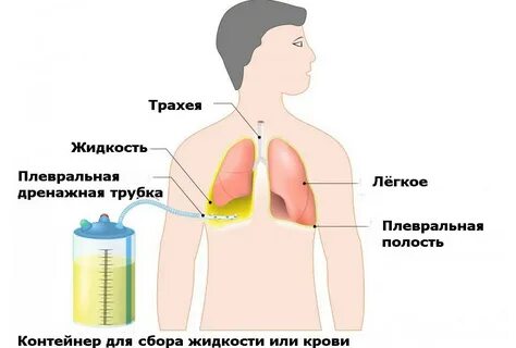 Удаление жидкости