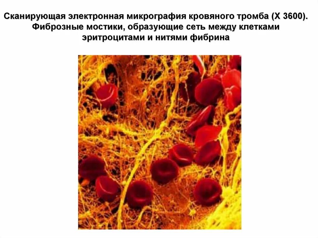 Кровяной тромб. Участвуют в образовании фибрина.