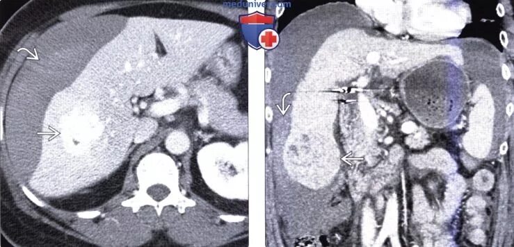 Гиперваскулярные метастазы печени кт. Гиповаскулярные метастазы печени кт. Гиперваскулярные образования селезенки кт. Гиперваскулярный очаг в селезенки кт. Гиперваскулярное образование печени