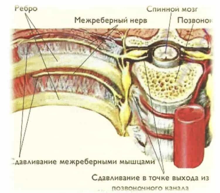 Межреберный нерв. Анатомия грудной клетки межреберная невралгия. Межребкрнпя неврология. Меж ребренная невралгия. Чем снять межреберную невралгию