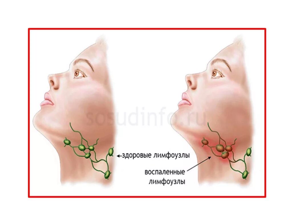 Лимфатический узел какой врач. Парвовирус лимфаденит. Воспаление лимфатических узлов. Воспаление лимфоузлов.