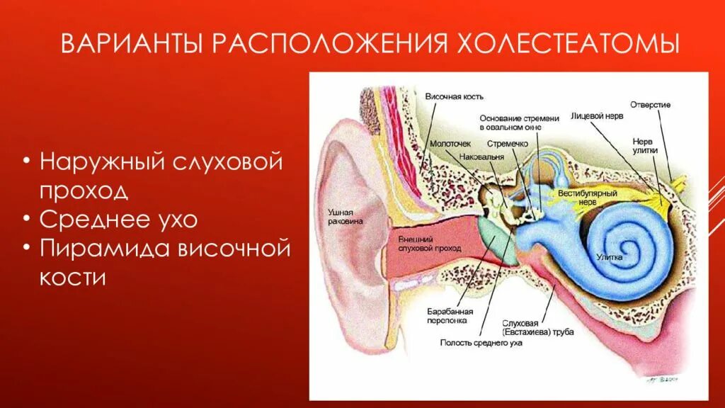 Холестеатома барабанной полости. Холестеатома сосцевидного отростка. Строение внутреннего уха анатомия косточки. Холестеатома ячеек сосцевидного отростка. Евстахиева труба внутреннее ухо