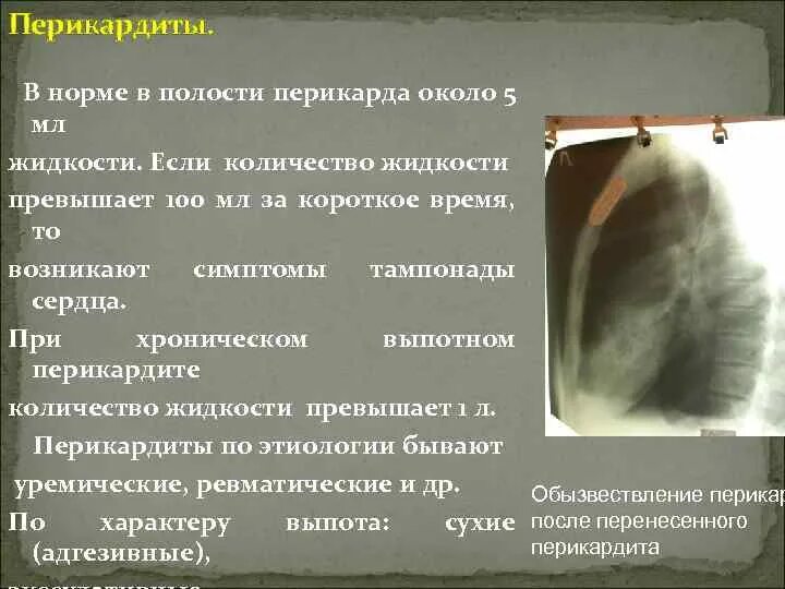 Скопление воздуха и крови в перикарде. Жидкость в полости перикарда норма в мм. Норма жидкости в перикарде. Жидкость в полости перикарда норма. Жидкость в полости перикарда на кт.