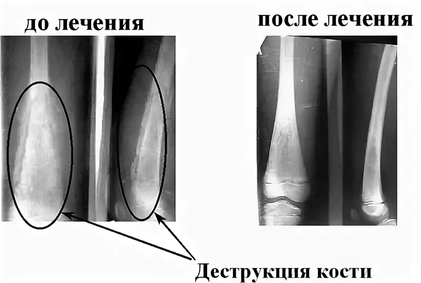 Остеоперфорация кости. Острый гематогенный остеомиелит у детей клинические рекомендации. Гематогенный остеомиелит презентация. Острый гематогенный остеомиелит остеоперфорация. Остеомиелит презентация.