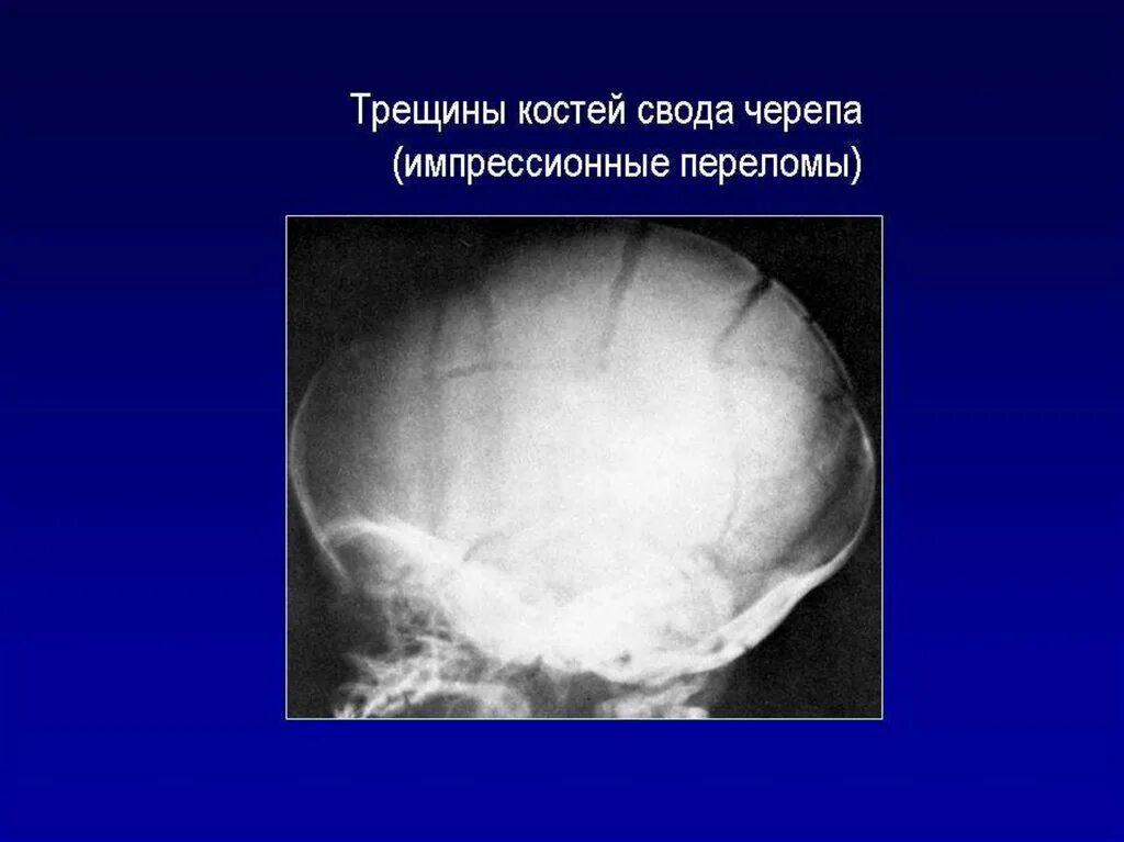 Перелом кости свода черепа. Гиперостоз лобной кости рентген. Гиперостоз костей черепа мрт. Гиперостоз костей свода черепа на мрт.