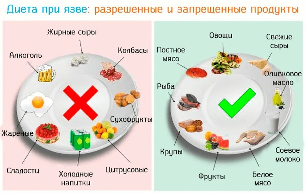 Какую еду можно есть. Рацион питания при язве желудка. Режим питания при язвенной болезни желудка. Лечебная диета 1 при язвенной болезни желудка. Продукты питания разрешенные при язвенной болезни желудка.