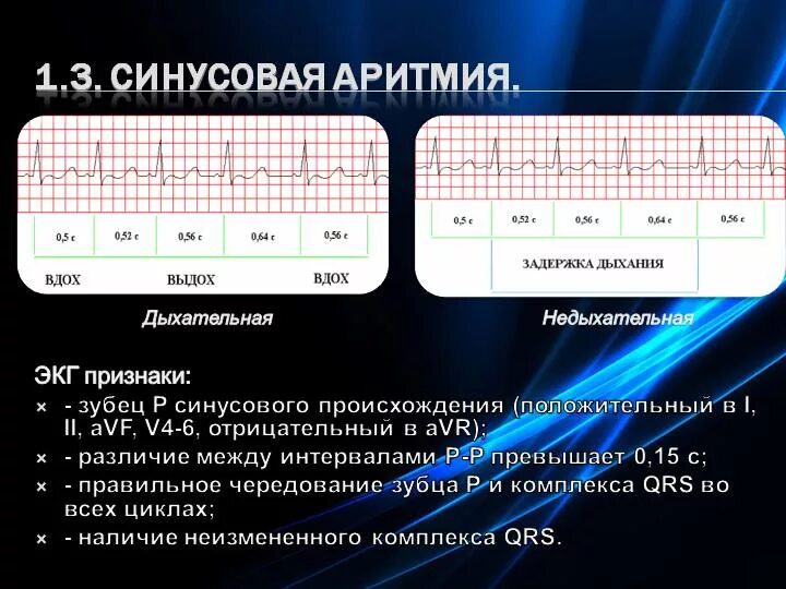 Синусовая аритмия на ЭКГ. Синусовая аритмия ЭКГ признаки. ЭКГ С синусовой аритмией сердца. ЭКГ критерии синусовой аритмии.