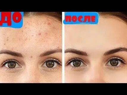 Народные методы от прыщей