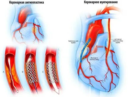Инфаркт миокарда стентирование жизнь после