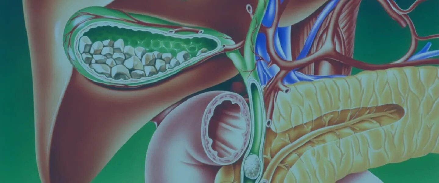 Желчнокаменная болезнь. Желчнокаменная болезнь картинки.