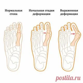 Вальгус форум
