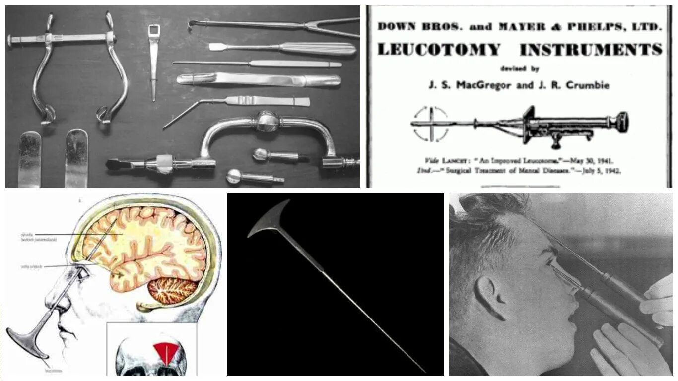 Лоботомия в россии. Лоботомия схема проведения. Нож для колки льда Лоботомия.
