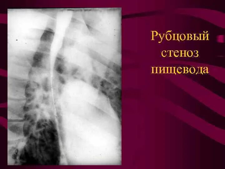 Сужение пищевода симптомы. Пептический стеноз пищевода. Опухолевая стриктура пищевода. Рубцовый стеноз пищевода рентген. Рубцовый стеноз пищевода субкомпенсированный.