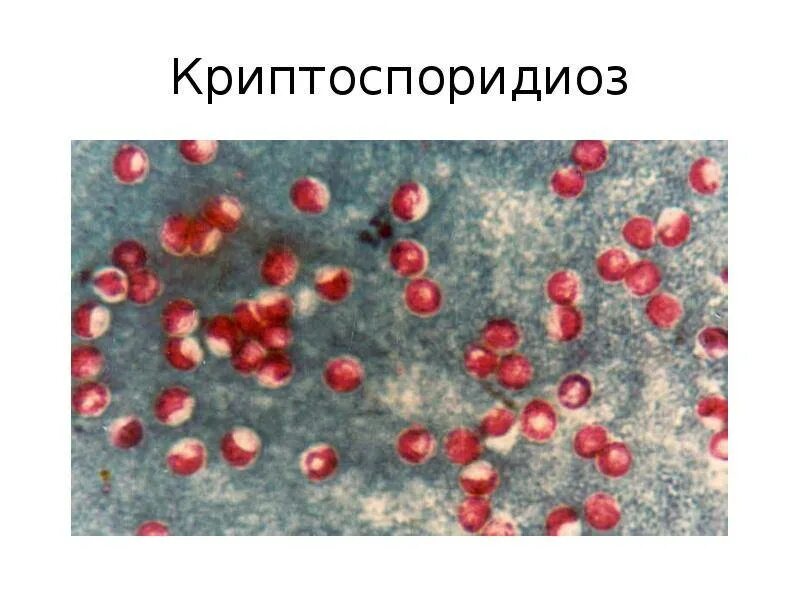 Криптоспоридиоз у вич инфицированных. Криптоспоридиоз лечение. Криптоспоридии при вич. Криптоспоридии микроскопия. Криптоспоридиоз возбудитель.