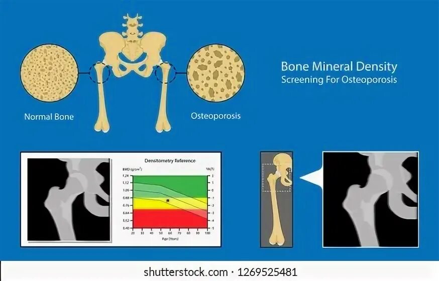 Bone mineral