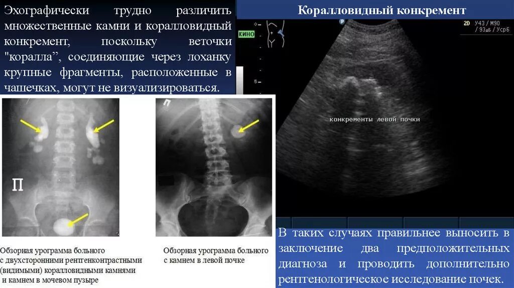 Конкремент латынь. Коралловидный камень в почке. Коралловидный конкремент в почке. Коралловидный конкремент правой почки. Коралловидный конкремент на УЗИ.