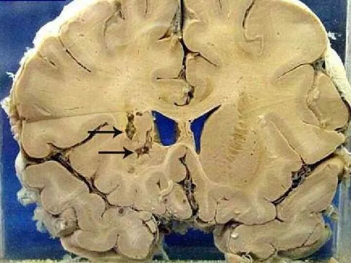 Рассеянный склероз макропрепарат. Губчатая энцефалопатия. Ишемический инфаркт мозга макро. Энцефалопатия макропрепарат. Хтэ болезнь