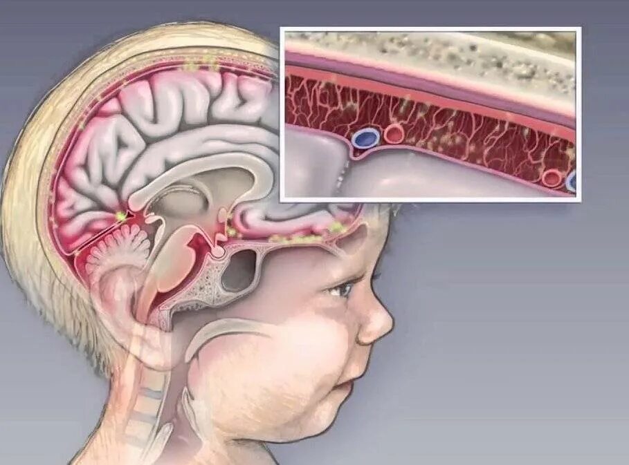 Отек мозга у новорожденных. Асептический серозный менингит. Серозный паротитный менингит. Менингит воспаление оболочек головного мозга. Цереброспинальный Гнойный менингит.