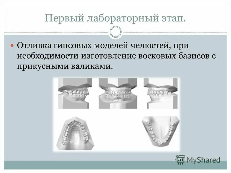 Этапы изготовления штампованной. Отливка гипсовых моделей лабораторный этап. Клинико лабораторные этапы штампованной коронки. Отливка моделей челюстей. Отливка гипсовых моделей челюстей.